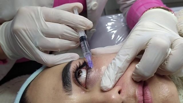 #Mezoterapiya #Мезотерапия Ko'z Atrofi Uchun Vitaminli Ukol