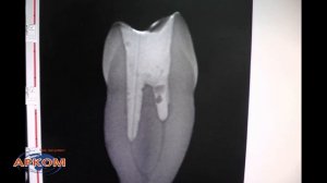 Удаление стекловолоконного штифта