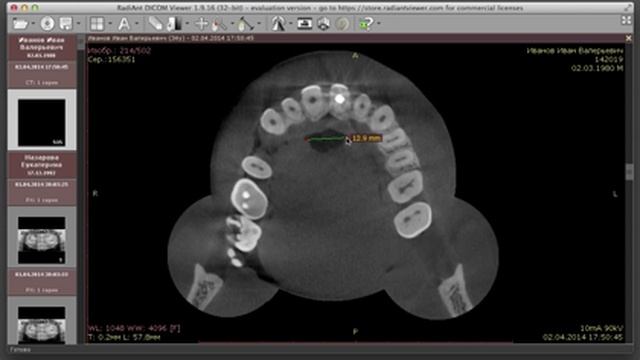 Radiant DICOM viewer для 3D. Знакомлюсь с программой. смотреть онлайн