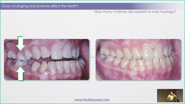 The Case for Rewards of Correcting Rest Oral Posture - William M. Hang, DDS, MSD смотреть онлайн