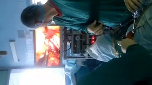 Лапароскопическая рак тела матки с придаки. смотреть онлайн