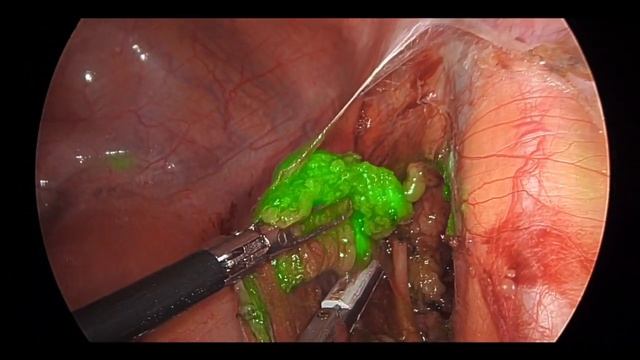ICG Fluorescence Technique for the Detection of Sentinel Lymph Nodes in Endometrial Cancer смотреть онлайн