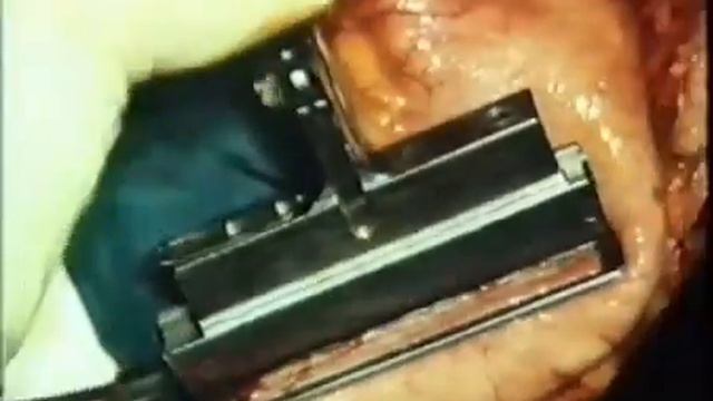 Пластика пищевода   Plastic Esophageal