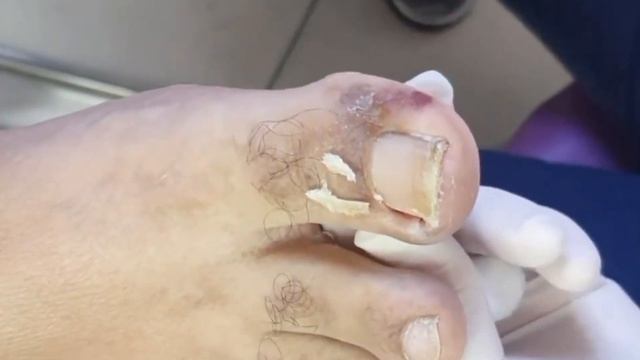 Вросший ноготь???⚠️??