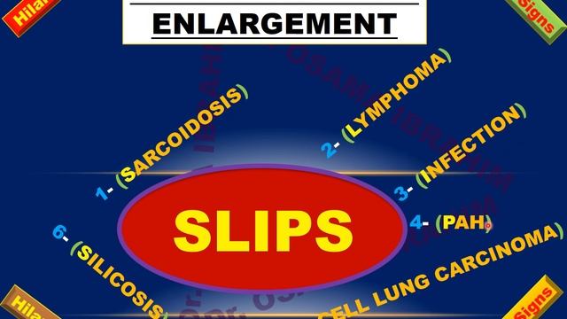 Bilateral Hilar enlargement and its relation to Hilar signs Part-2 смотреть онлайн