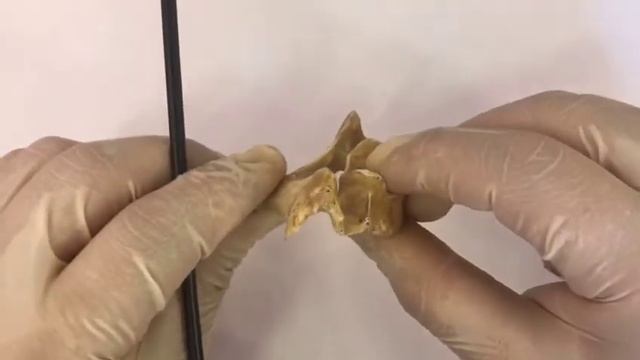 Седьмой шейный позвонок - Vertebra Prominens смотреть онлайн