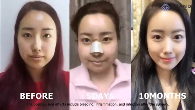 Ринопластика в клинике Гранд, Сеул