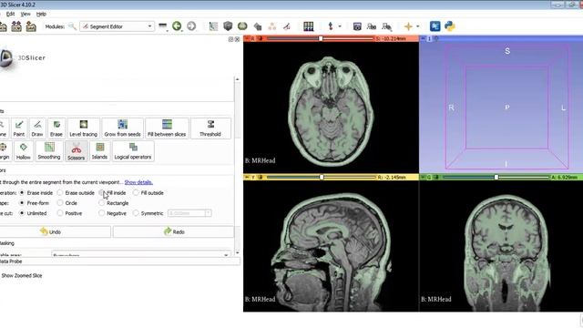 Skull Stripping in 3D Slicer смотреть онлайн