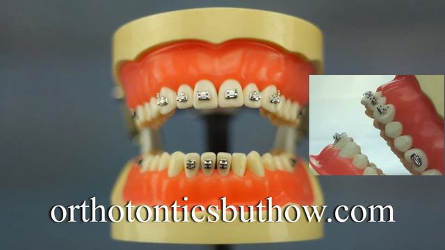 How to place the orthodontic bracket on the teeth ? - Correct orthodontic bracket positions - смотреть онлайн