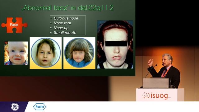 22q11.2 deletion syndrome: Ultrasound features and opportunities for screening using cell-free DNA смотреть онлайн
