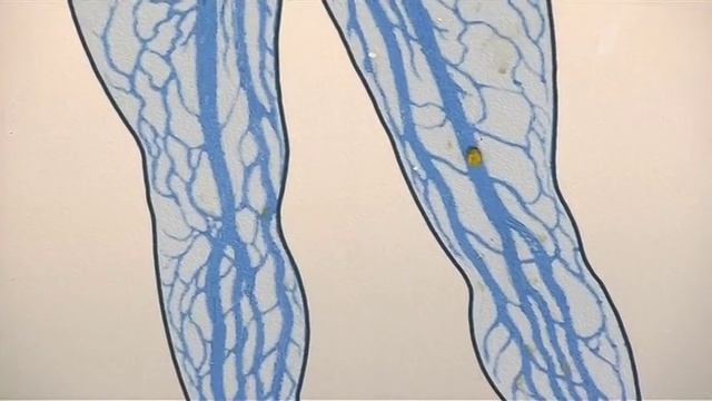 Тромбоз глубоких вен. Как избежать осложнений смотреть онлайн