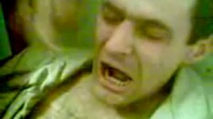 Удаление зуба плоскогубцами