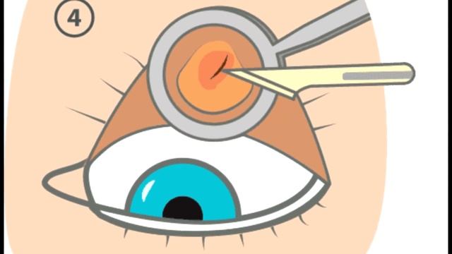 Как вживляют чипы в глаза или может это болезнь?! смотреть онлайн