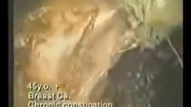 Видео толстого кишечника изнутри смотреть онлайн