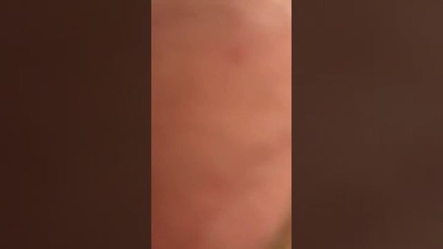 Пересадка волос до и после отлично результат #пересадкаволос