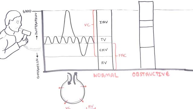 Understanding Spirometry - Normal, Obstructive Vs Restrictive