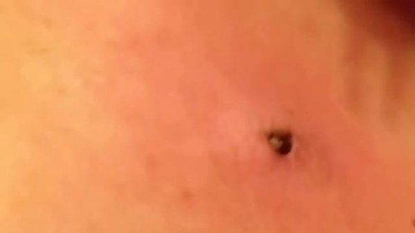 Удаление угрей 25 лет