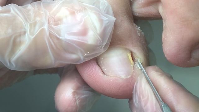 It hurts too much! Proliferated yellow nails!【DrZhang】 смотреть онлайн