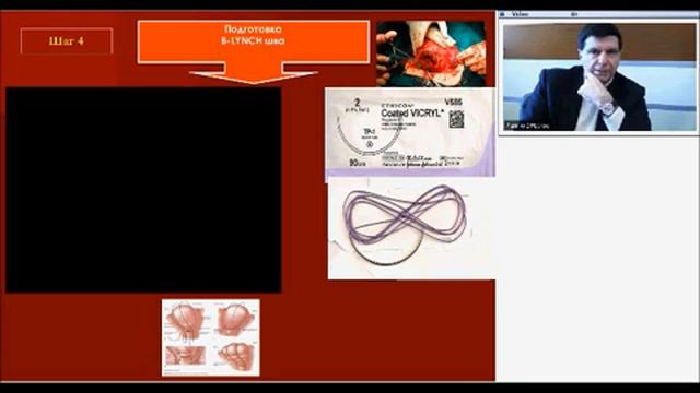 Ди Ренцо О баллонной тампонаде 23 января 2013 смотреть онлайн