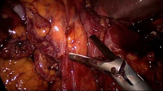 Laparoscopic subototal gastrectomy for gastric ca of pylorus & intracorporeal gastroJJ anastomosis смотреть онлайн