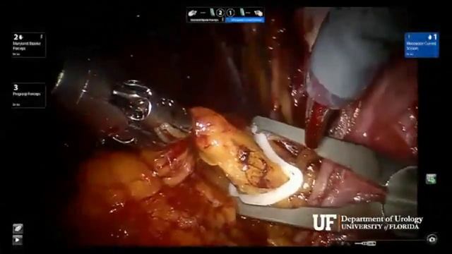 Pelvic Lymph Node Dissection || Step by Step Procedure || Urology || смотреть онлайн