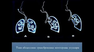 Упка уткир йирингли деструктив, сурункали носпецифик касалликлари ва плевра касалликлари