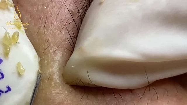 Best blackheds and pimple popping (323) | Loan Nguyen смотреть онлайн
