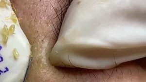 Best blackheds and pimple popping (323) | Loan Nguyen
