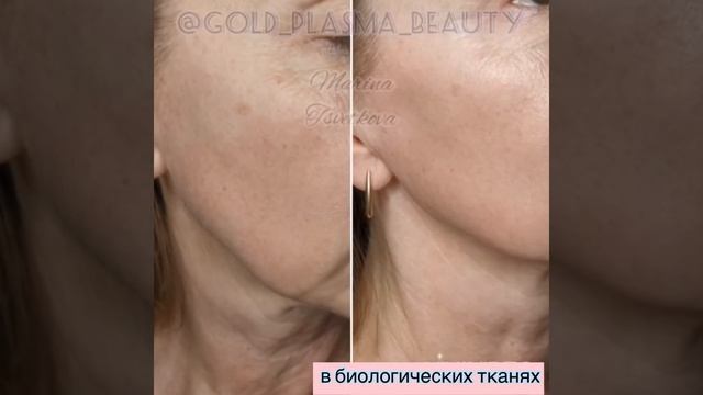 Холодная Плазма- молодость и красота кожи без инъекций и скальпеля! смотреть онлайн