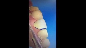 Чем приклеить зуб в домашних условиях, чтобы такого не было, и есть ли супер клей для зубов?