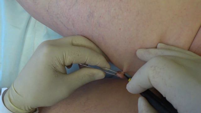 радиохирургическое удаление крупной мягкой фибромы