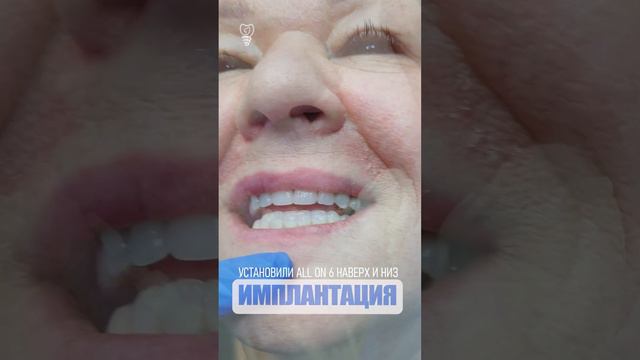 Установили all on 6 наверх и низ. Installed all on 6 up and down. Implantation смотреть онлайн