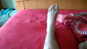 Перелом мыщелка большеберцовой кости (часть 1 из 5)