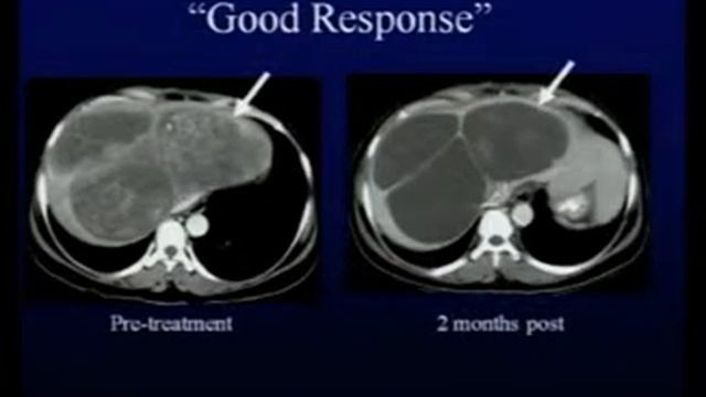 Haesun Choi, MD Radiologic imaging Responding or Not Responding Lessons from the GIST Model Intr смотреть онлайн