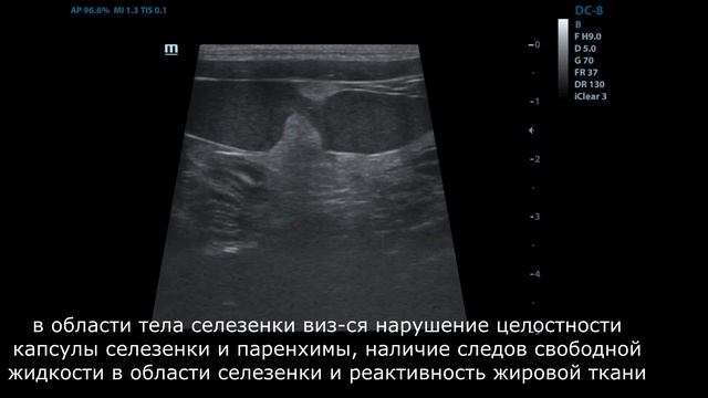 УЗ-патологии селезенки смотреть онлайн