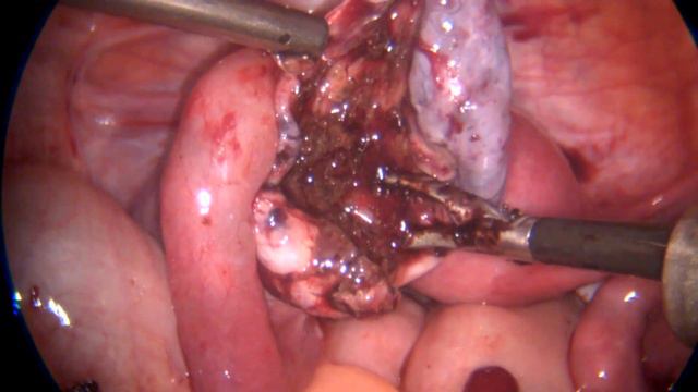 Апоплексия разрыв яичника. Laparoscopic management of bleeding due to apoplexy of the left ovary смотреть онлайн