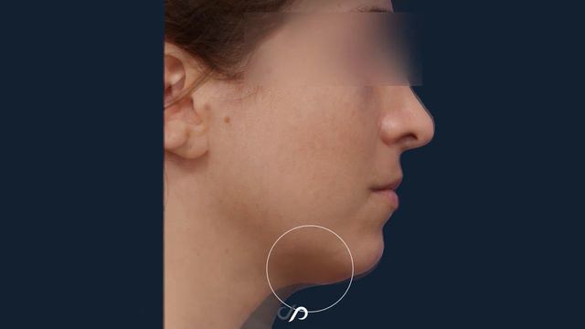 How to Get Rid of the Double Chin | Dr. David Stoker смотреть онлайн