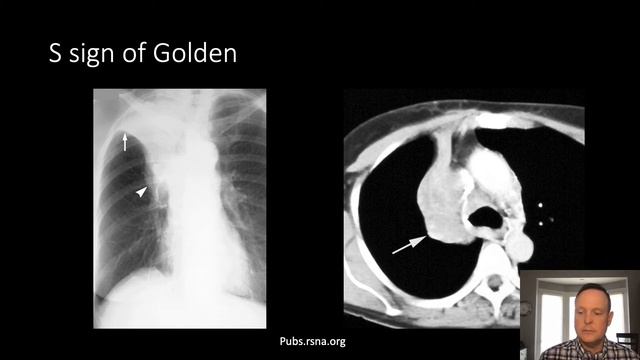 BASICS OF THORACIC CANCER: Mini-lecture, Dr. Chris Cox смотреть онлайн