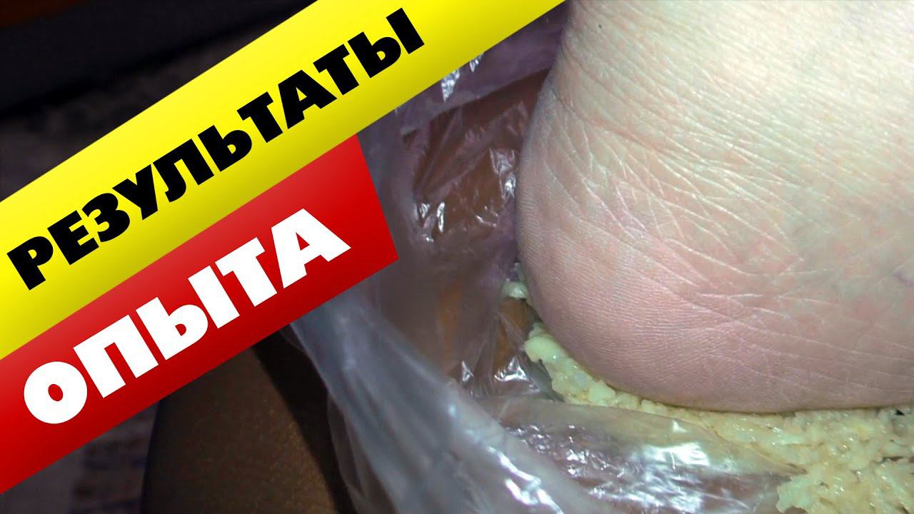 Шпоры на ногах Попытка №1 ЧЕСНОК - ОТЗЫВЫ смотреть онлайн