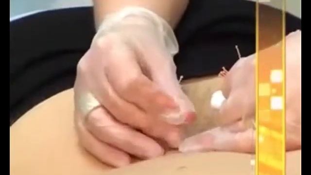 Рефлексотерапия в клинике "Проксимед" смотреть онлайн