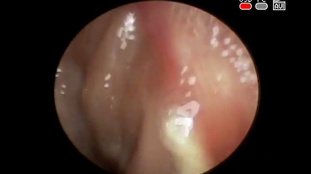 Хронический #тонзиллит, камень #миндалины, диагностика лечение #ЛОР врач КЛИНИКА ОБРАЗЦОВА смотреть онлайн