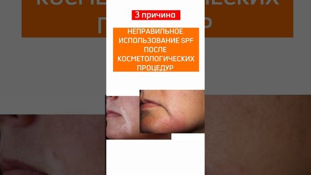 Какие существуют причины пигментации? #пигментация смотреть онлайн