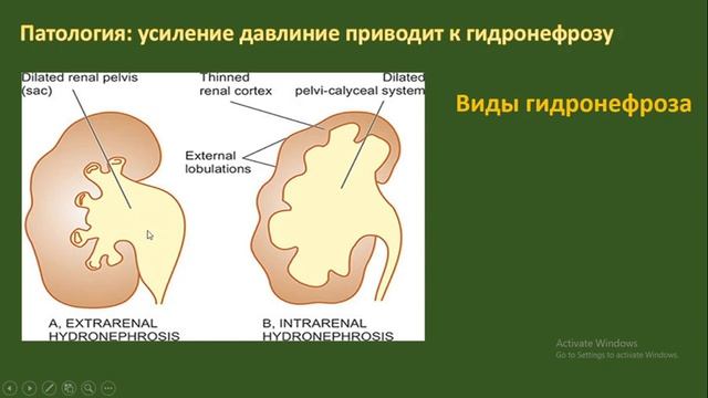 гидронефроз (определение, этиология и причины, патология, диагностика, клиника, виды, лечение) смотреть онлайн