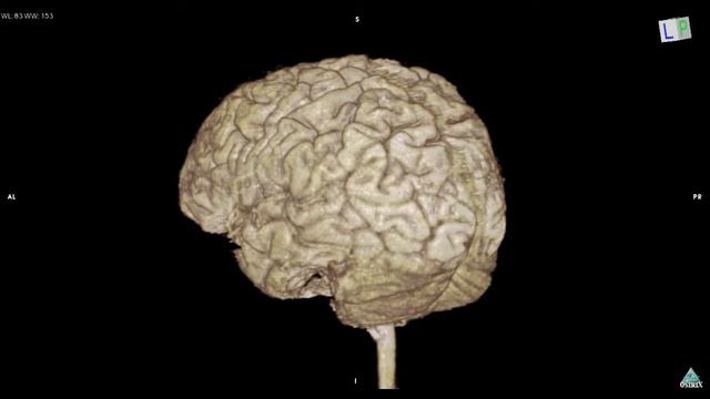 Variation of brain cortex 3D MRI sample I,d]o смотреть онлайн