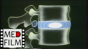 Остеохондроз позвоночника © Osteocondritis of the spine