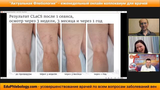 Гиперпигментация при склеротерапии: практические советы (врачебная версия)