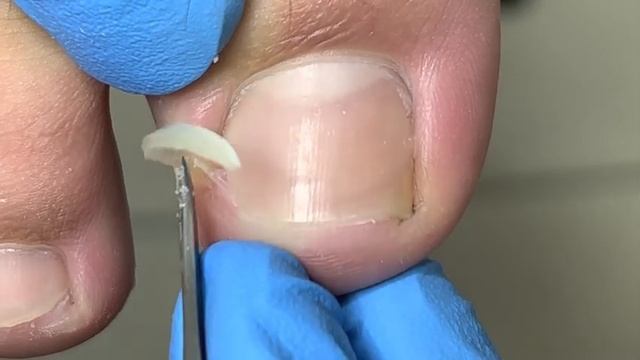 1 minute simple solution to ingrown nails!【Xue Yidao Pedicure】 смотреть онлайн