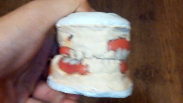 постановка зубов под нейлоновые протезы. смотреть онлайн