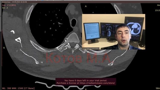 Перелом лопатки. Ролик №49 смотреть онлайн