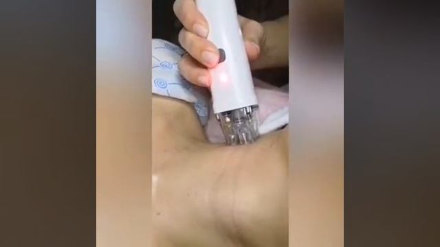 RF - лифтинг смотреть онлайн